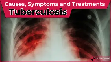 Tuberculosis article header – First Aid Article in Nelson Bay